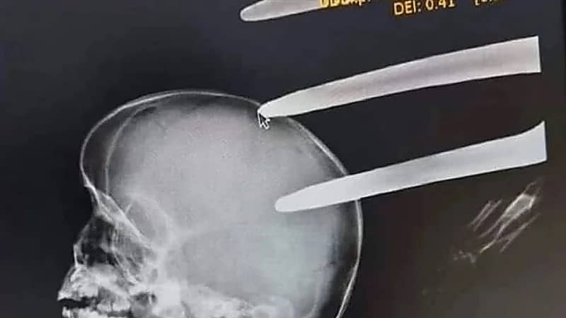 مصرع طفل بـ شوكة في الرأس أثناء لعبه