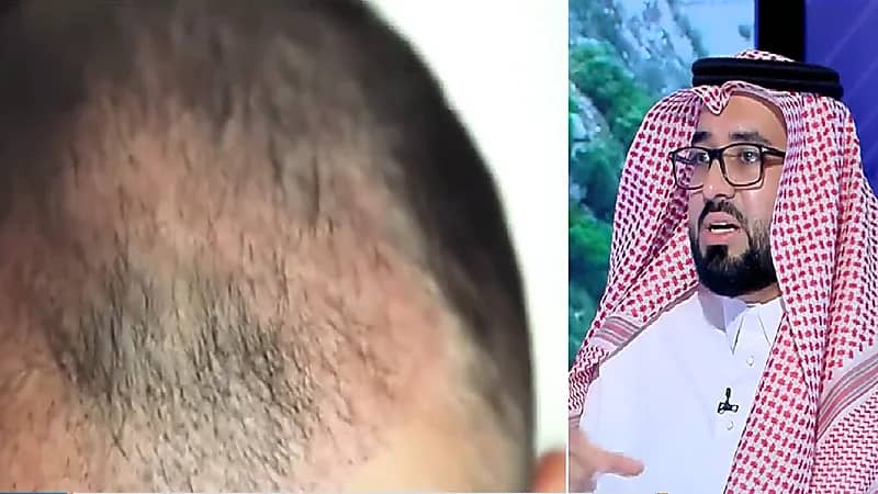 استشاري: استخدام البخاخات الموضعية من أهم أسباب تساقط الشعر