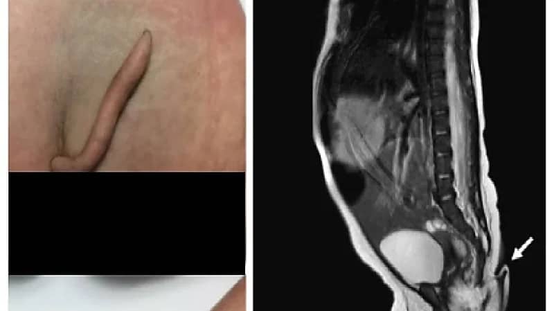 ولادة طفلة بذيل طوله 6 سم في حالة نادرة