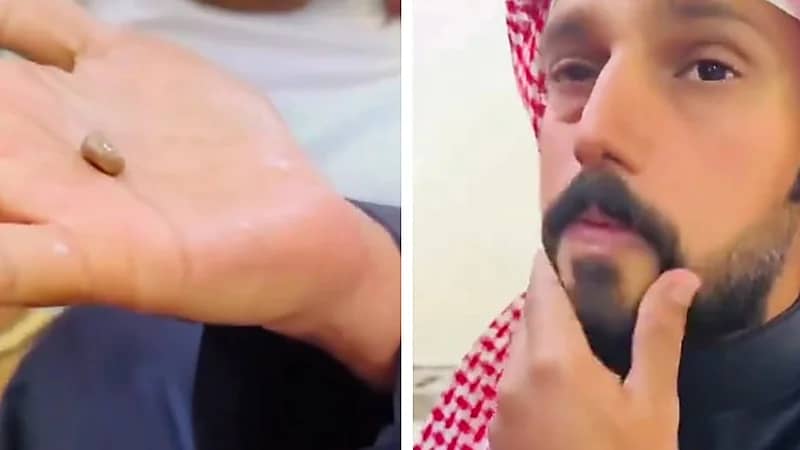 مُسنة معالجة تستخرج حجر من عين رجل واستشاري يعلق..فيديو