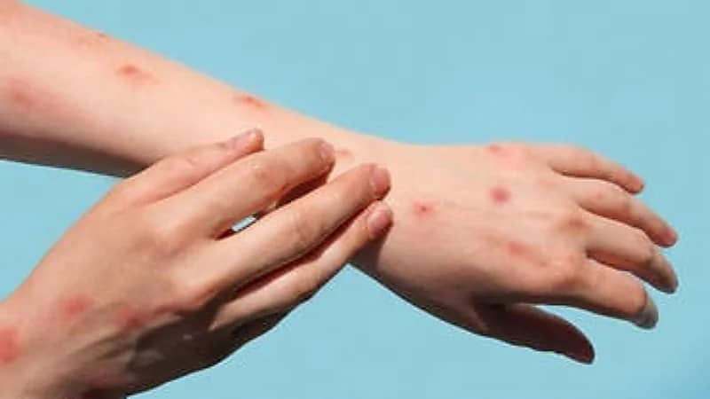 لماذا لم يتحول جدري القردة إلى وباء مثل كورونا ؟ نزار باهبري يكشف .. فيديو