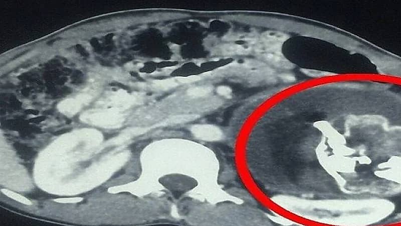 أطباء يستخرجون جنين طفيلي من بطن رضيع