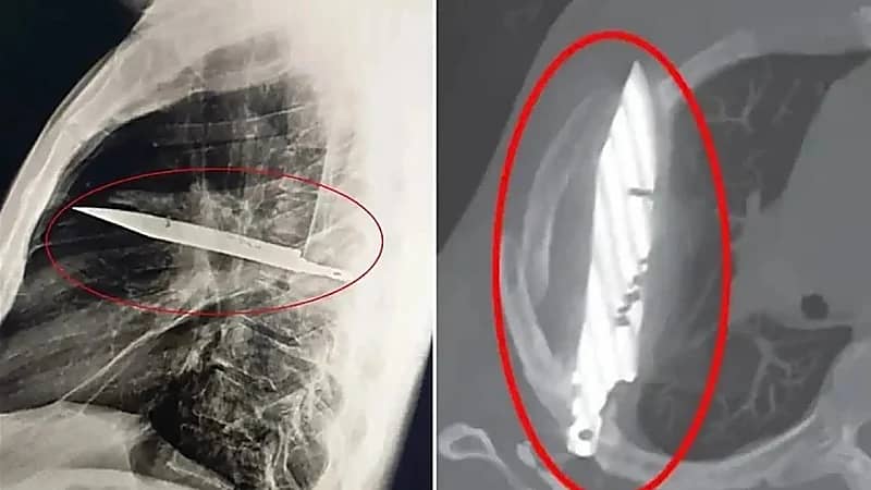 استخراج سكين علق بصدر شاب 8 أعوام