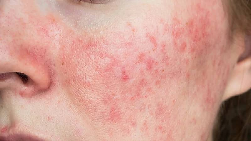 نصائح للعناية بالبشرة الحساسة والحد من مشاكل الوردية