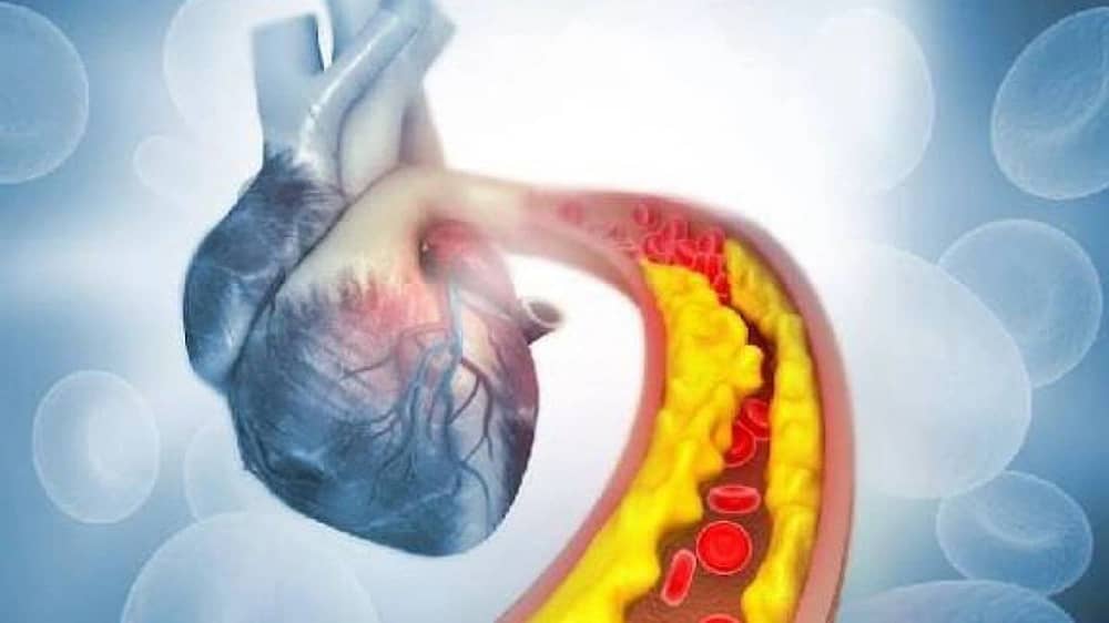 النمر: 10 عوامل تزيد من سرعة تكلّس الشرايين التاجية