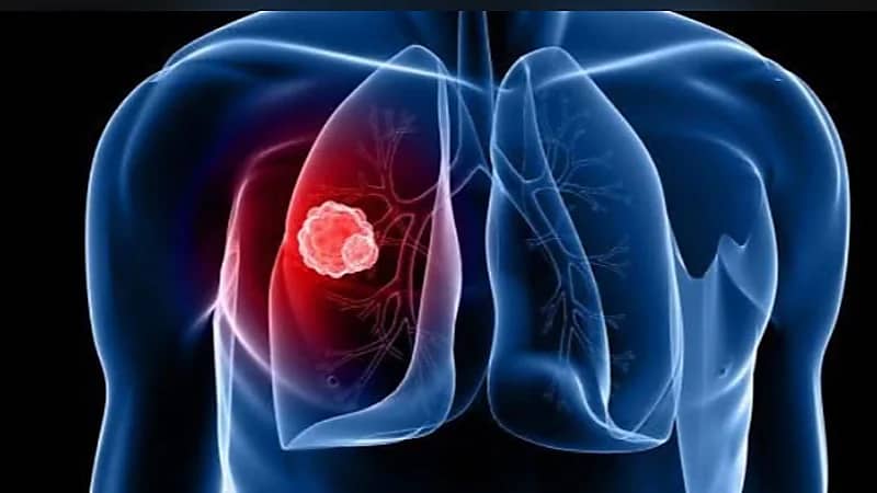 أبرز 6 أعراض مبكرة لسرطان الرئة