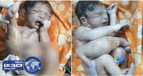 بالفيديو.. ولادة نادرة لطفل بأربعة سيقان وثلاث أذرع