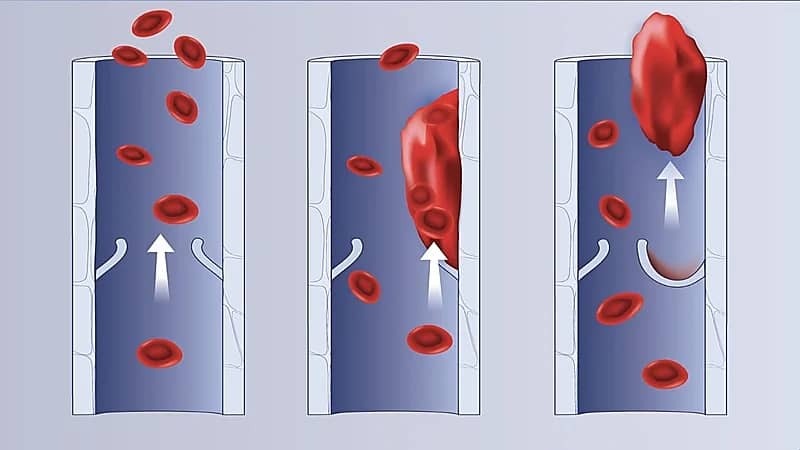المجلس الصحي السعودي يوضح إحدى طرق الوقاية من الجلطات الوريدية