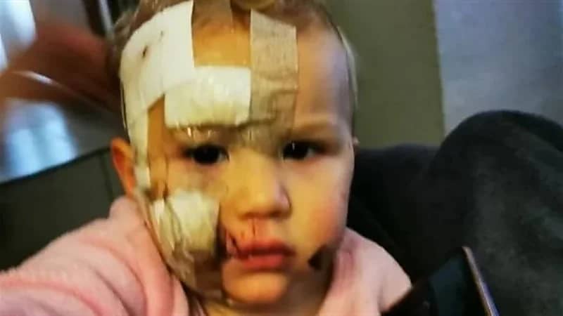 طفلة تتعرض لهجوم وحشي من كلب