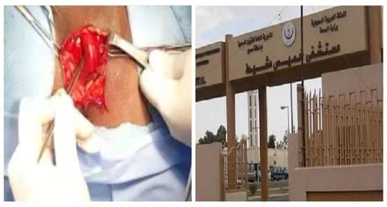 أطباء خميس مشيط ينجحون في إجراء عملية نوعية لمقيم باكستاني