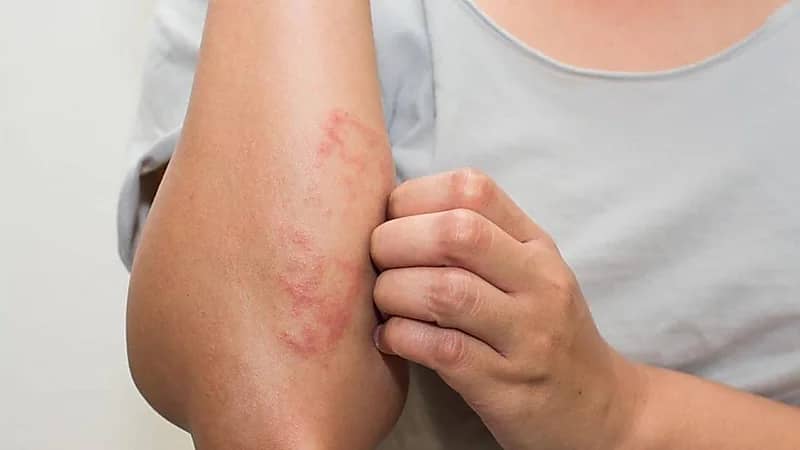 هل يمكن معالجة الاكزيما باستخدام الحجامة؟.. "الخضيري" يُجيب