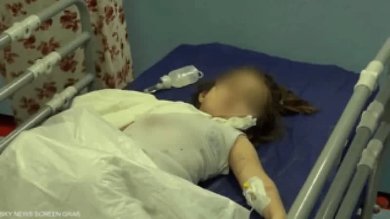 العراق.. دب ينهش ذراع طفلة