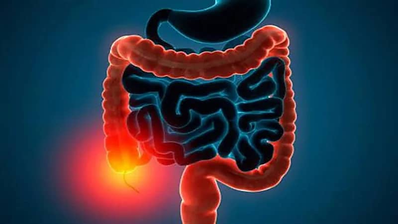 أعراض تشير إلى الإصابة بمتلازمة القولون