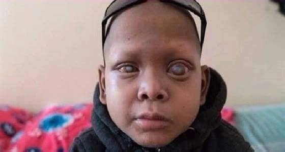 بالفيديو :حالة نادرة. .طفل يذرف دماً بدل الدموع