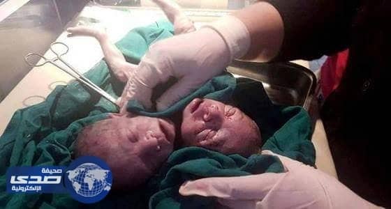 وفاة توأم بجسد واحد ورأسين بعد ولادته بساعات