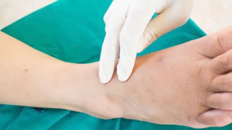 طرق مختلفة لعلاج القدم السكري