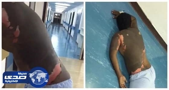 تدهور حالة الزوج المحروق بالزيت المغلي على يد زوجته بـ " بيشة "