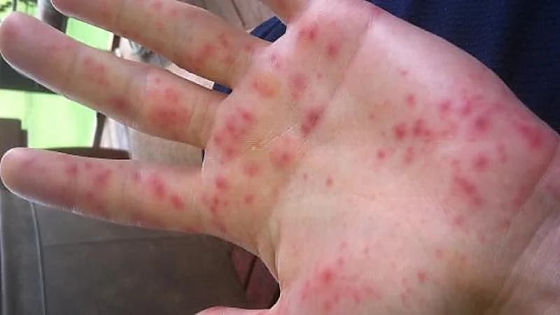 علامة في اليد تُنذر بإصابة الإنسان بمرض خطير