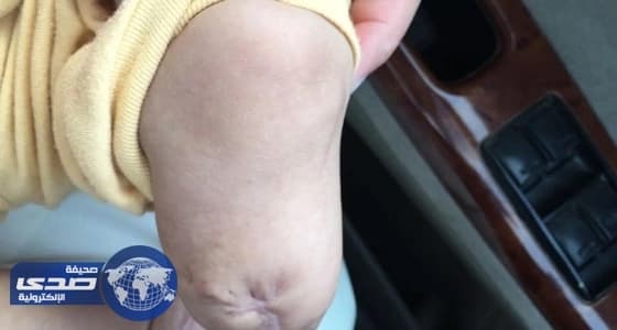 «الهيئة الشرعية» تحقق في واقعة بتر قدم الطفل «خالد»