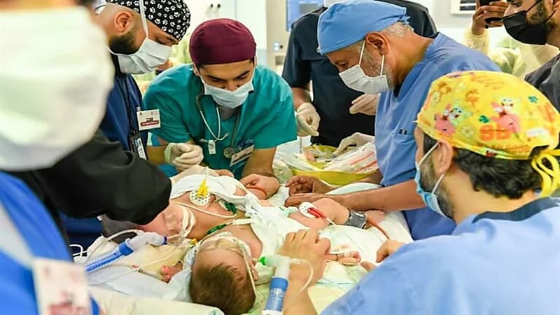 بالفيديو.. "الربيعة" يعلن نجاح عملية فصل التوأم السيامي اليمني