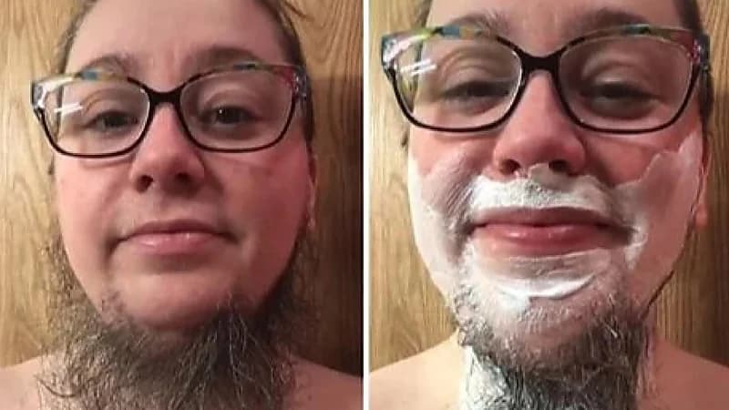 امرأة مصابة بتكيس المبايض تثير جدلاً واسعًا بسبب لحيتها