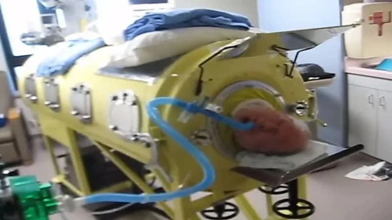 حالة نادرة.. رجل يعيش برئة حديدية 76 عاماً