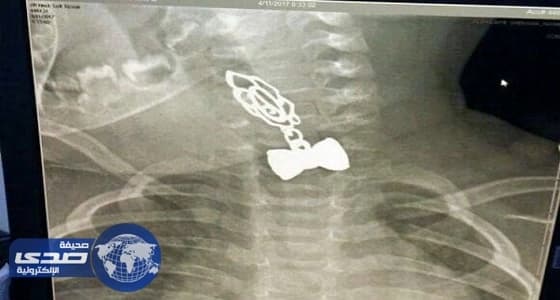 استخراج قطعة معدنية من بلعوم طفل رضيع