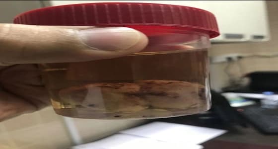 استئصال ورم من فم مولود بمستشفى الولادة والأطفال بأبها