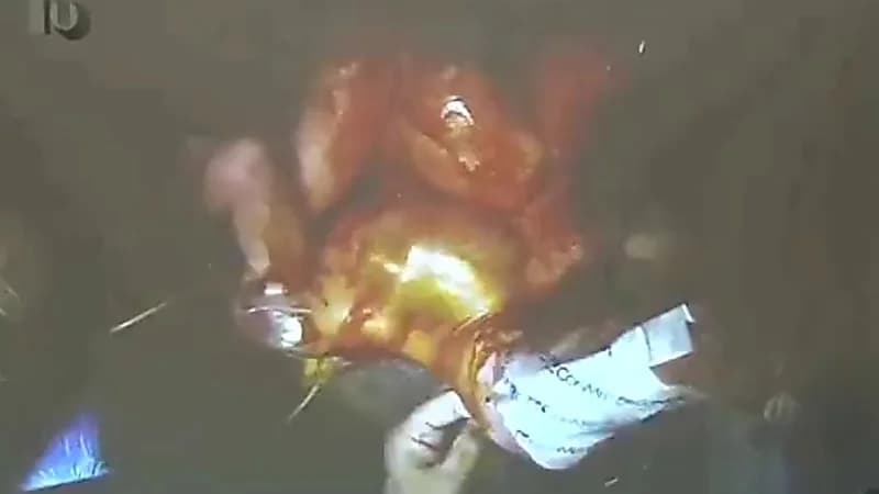 شاهد.. لقطات مباشرة لعملية فصل التوأم السيامي العراقي