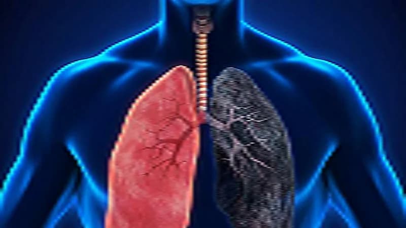 أبرزها تحول الشفاه للون الأزرق.. أعراض الانسداد الرئوي المزمن في فصل الشتاء