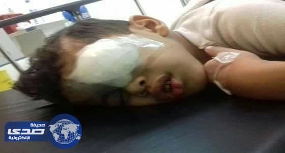 انفجار لعبة نارية تلحق ضرر بالغ بعين طفل