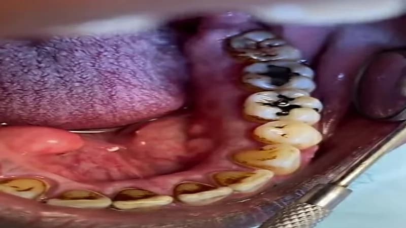 شاهد.. طبيبة توثق أضرار التدخين على الأسنان