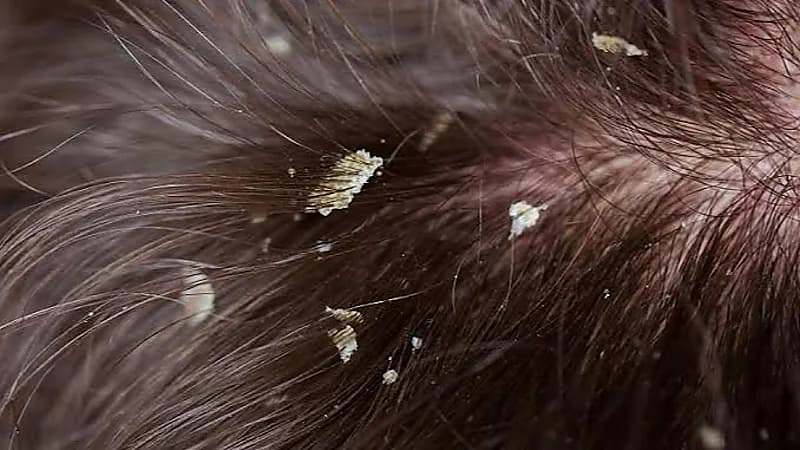 طريقة مدهشة للتخلص من قشرة الشعر نهائيًا