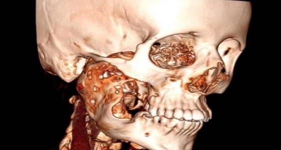 فريق طبي ينقذ فتاة عشرينية من ورم عدواني يأكل في عظم الفك