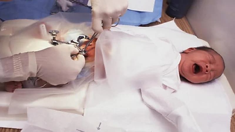 طبيب يتسبب في تشوه الجهاز التناسلي لطفل أثناء "الختان"