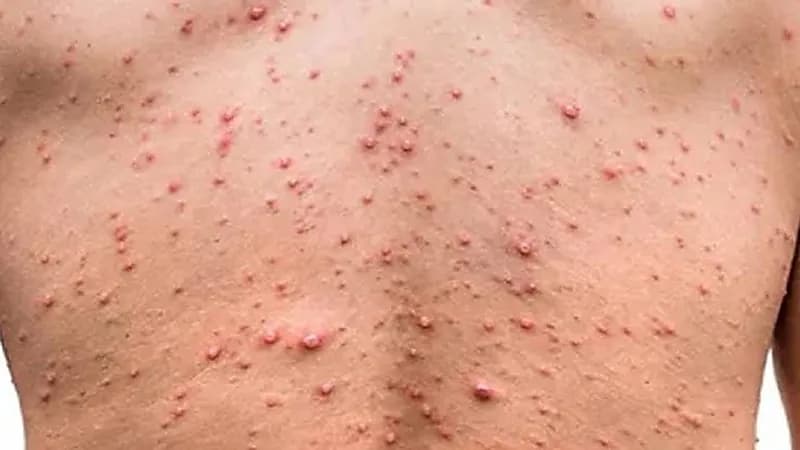 أمريكا تطالب المثليين والمثليات بالتسجيل للحصول على لقاحات جدري القرود