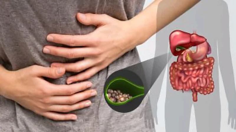 استشاري يكشف عن 5 عوامل تسبب حصوات المرارة