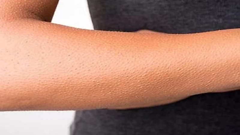 السكر والشمع أفضل طريقة للتخلص من جلد الوزة