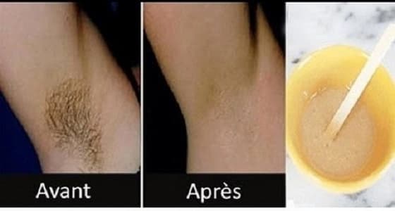 وصفة جديدة للتخلص من الشعر الزائد بدون أضرار