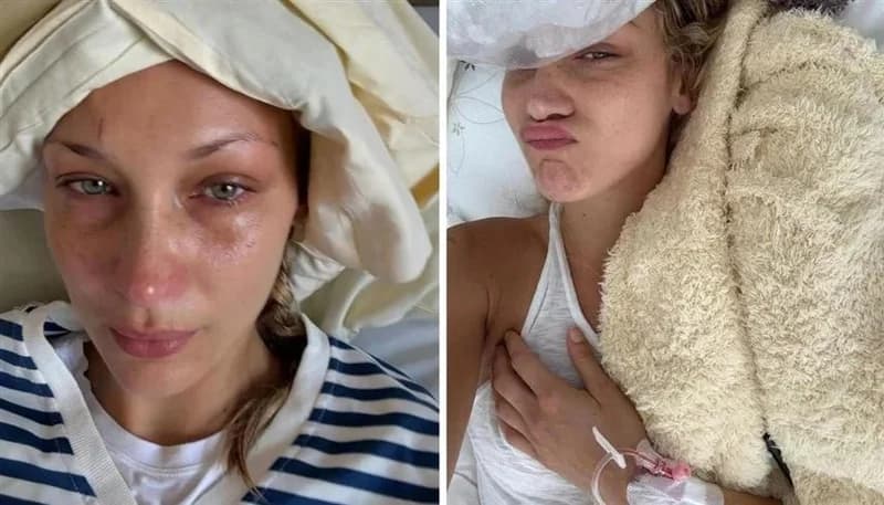 بيلا حديد تكشف عن معاناتها من مرض لايم المناعي.. صور