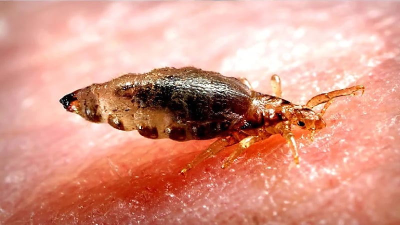 بالفيديو .. استشاري: القمل قد ينقل أمراض للجسم