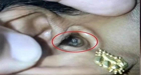 بالفيديو.. طبيب يعثر على عنكبوت حي يتحرك داخل أذن سيدة
