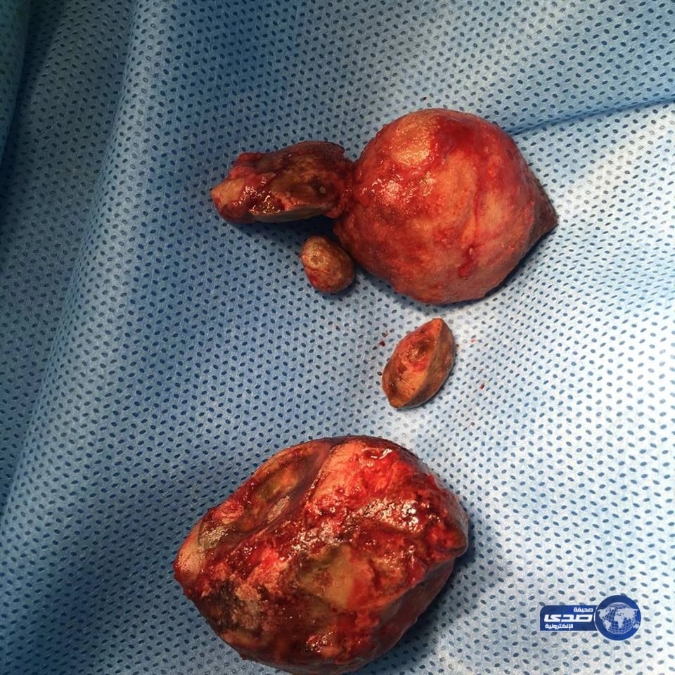 فريق طبي بمستشفى خميس مشيط ينجح في تعديل وتوسيع لعنق المثانة واستخراج 3 حصوات كبيرة لمسن