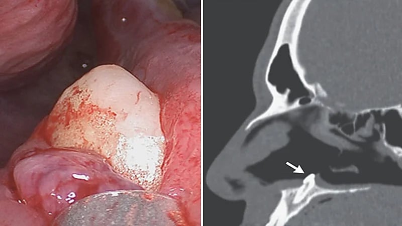 رجل يعاني من صعوبة التنفس بسبب نمو سن داخل أنفه