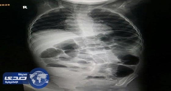 فريق طبي بعفيف ينجح في إعادة ترميم أمعاء طفل متهتكة