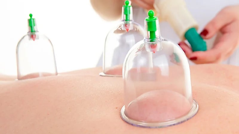 مختص يوضح أثر الحجامة على مرضى الروماتيزم