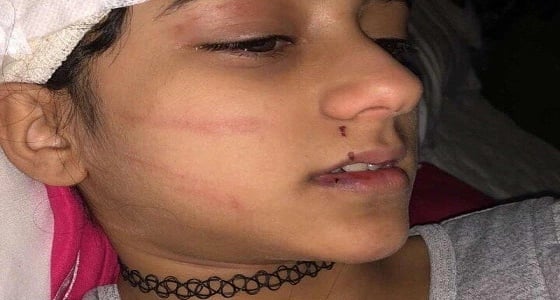 فيديو.. والد طفلة السوشيال ميديا يكشف تفاصيل هجوم نمر مفترس عليها