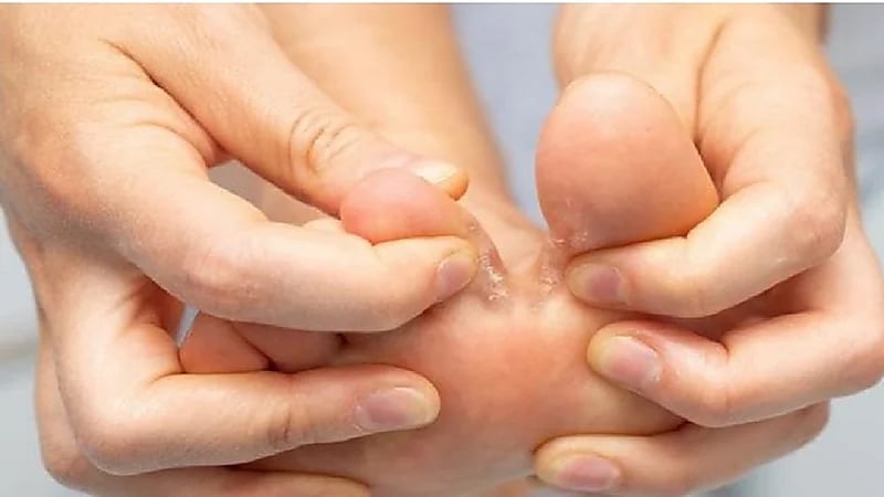 سعود الطبية تبرز عوامل الوقاية من الإصابة بالقدم الرياضية