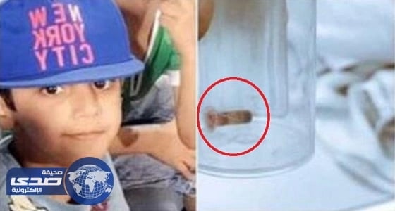 إزالة جسم غريب من رئة طفل بعد عامين