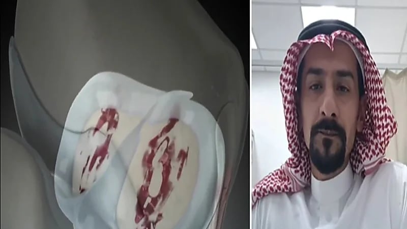 استشاري: استبدال مفاصل الركبة من أنجح العمليات في تاريخ الجراحة(فيديو)